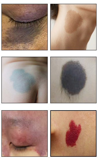 宝宝胎记颜色变深？什么原因会导致这种情况出现？南京胎记专科医院排名情况如何？