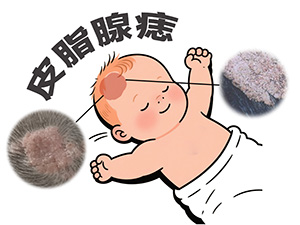 皮脂腺痣一定要手术吗，可以不管它吗？